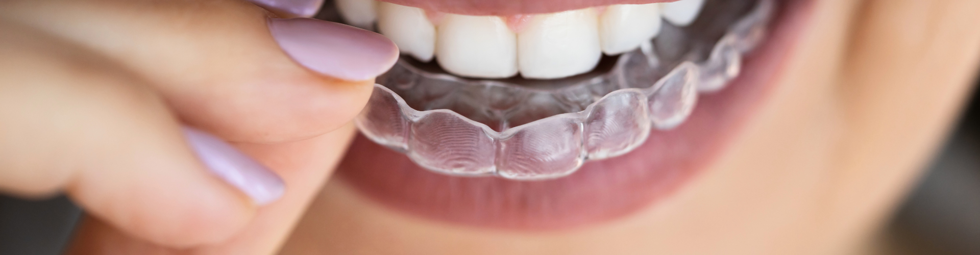 Woman placing clear aligner onto upper teeth.